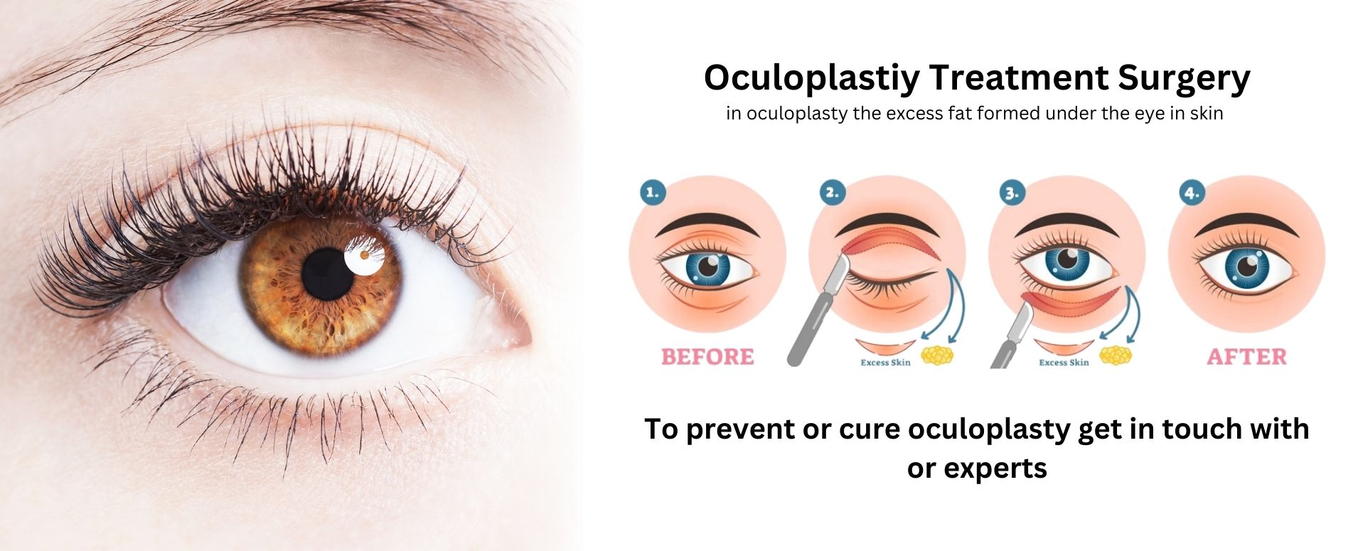 ocuplasty